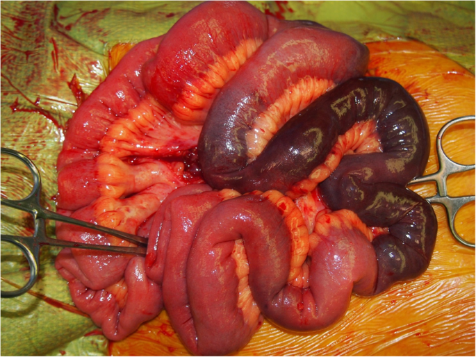 <p>Necrosis of proliferative intestinal mucosa</p>