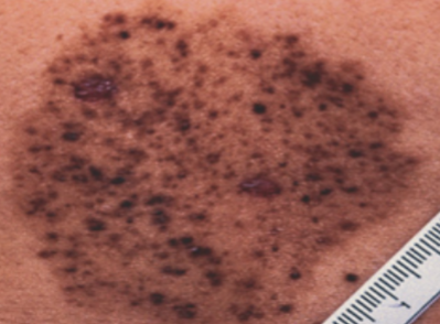 <p>nevus spilus</p>