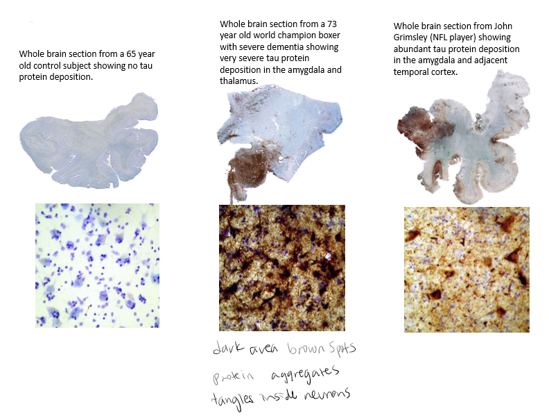 <p>Tau stained brown. Cell nuclei stained blue. </p>