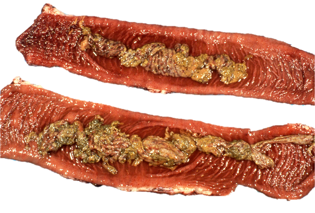 <p>What type of exudate is shown?</p>