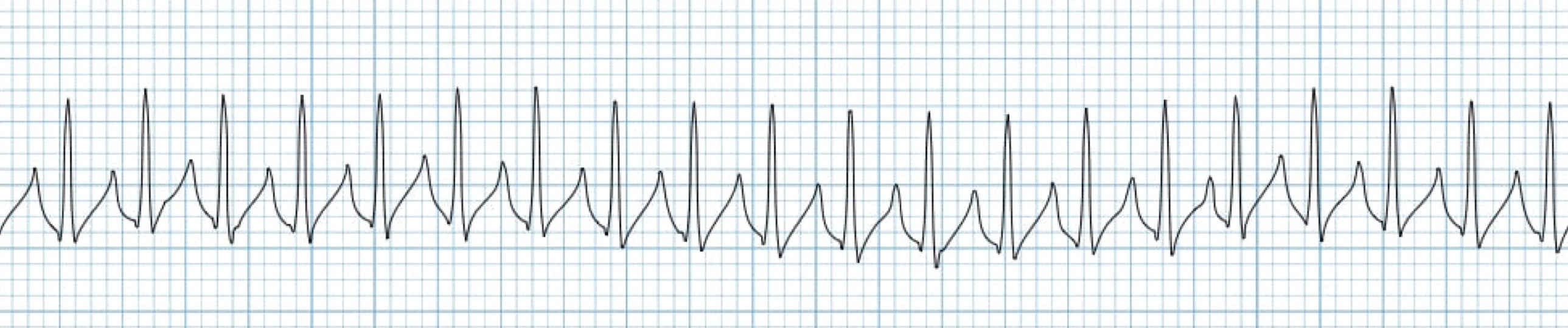 <p>What rhythm/abnormality is seen below?</p>