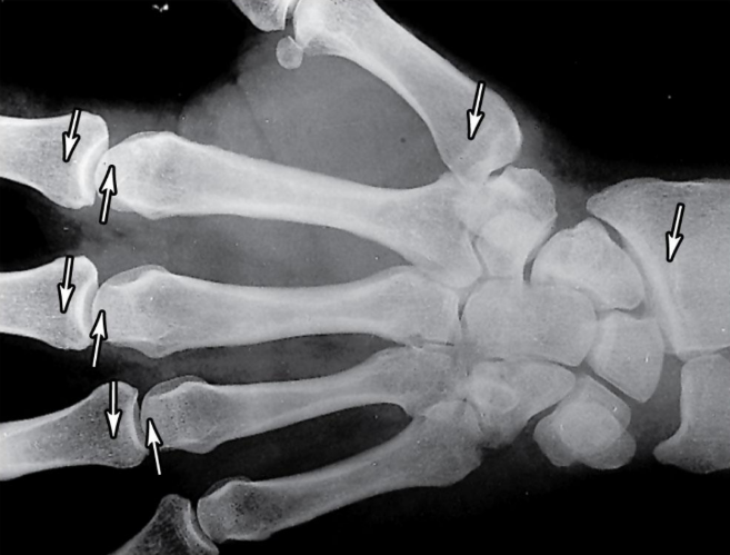 <p>When long bone stops growing, after puberty:</p>