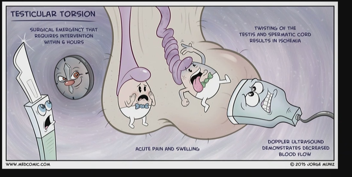 <p>Testicular torsion </p><ul><li><p>When the cord that provides blood flow to the testice twists and cuts of the blood supply </p></li><li><p>No blood flow </p></li></ul><p></p>