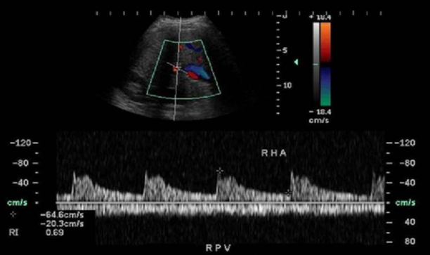 <p>the doppler evaluation displays a waveform from the hepatic artery and portal vein. What can be said about it?</p>