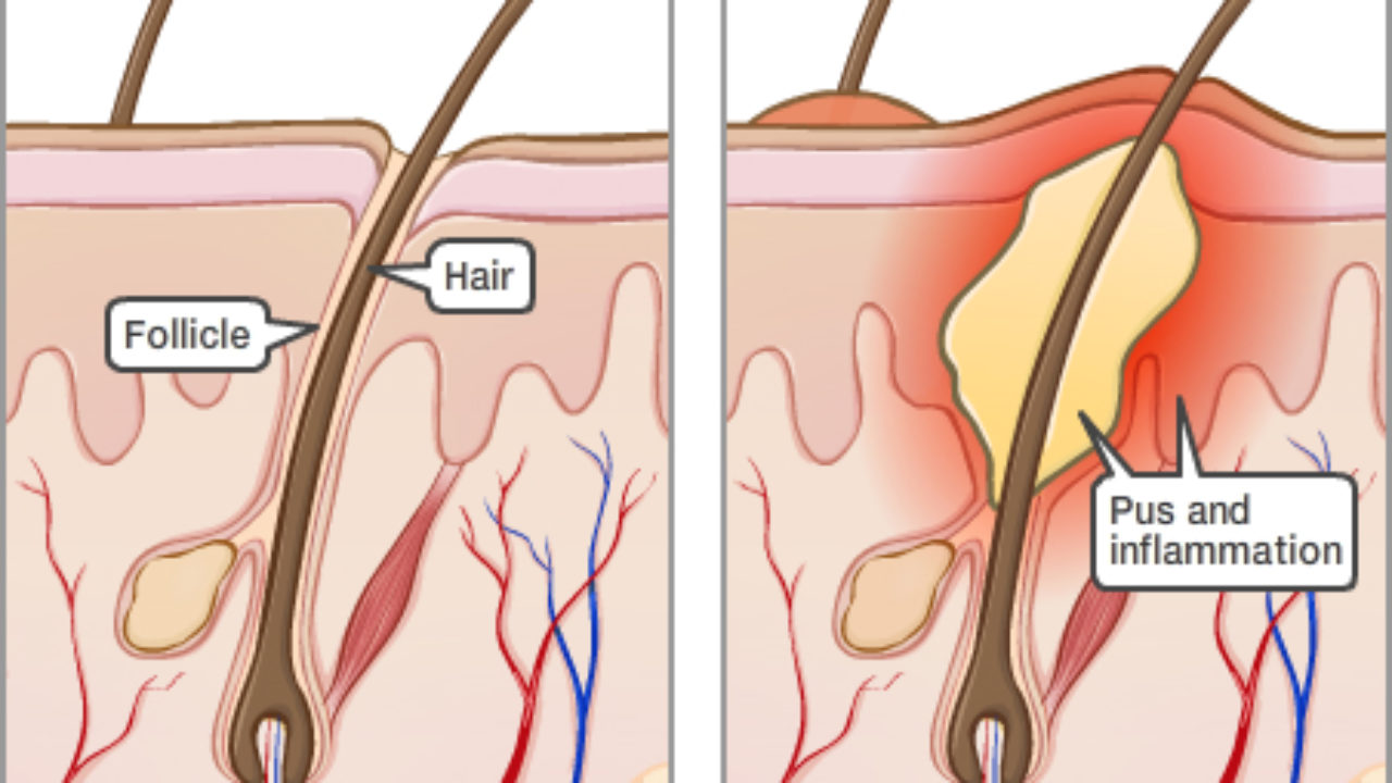 <p>Inflammation of a hair follicle.</p>