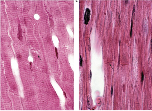 <p>The neonate develops a cardiac arrhythmia characterized by irregular and poorly coordinated heart contractions. A histologic image of the affected heart tissue is shown.</p><p></p><p><strong>Damage to which specialized structure in this tissue would most directly contribute to the arrhythmia?</strong></p><p><span>a. Sarcomeres</span></p><p><span>b. Intercalated discs</span></p><p><span>c. Branching muscle fibers</span></p><p><span>d. Tight junctions</span></p>