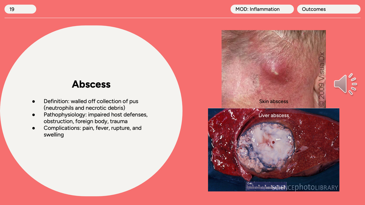 <p>Abscess</p><p></p><p><span>Impaired host defenses, obstruction, foreign body, trauma. </span></p><p></p><p><span>pain, fever, rupture, and swelling</span></p><p></p><p>What's in the pus?</p><p><span data-name="green_circle" data-type="emoji">🟢</span> <strong>Neutrophils</strong> (dead and alive)<br><span data-name="green_circle" data-type="emoji">🟢</span> <strong>Bacteria</strong> (if infection is present)<br><span data-name="green_circle" data-type="emoji">🟢</span> <strong>Necrotic tissue debris</strong><br><span data-name="green_circle" data-type="emoji">🟢</span> Fluid</p><p></p><p>●<strong>Requirements for abscess formation:</strong> The body cannot rid itself of the inciting agent, or the process of repair and scarring is occurring more rapidly in the tissue around the site of the abscess.</p>