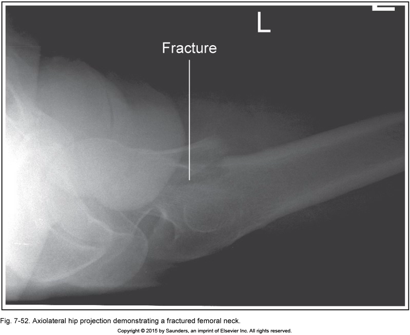 <p>hip axiolateral (danelius-miller/x-table)</p>
