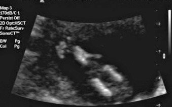 <p>Fusion of the lower extremities</p><p>Bilateral renal agenesis therefore leading to</p><p>Oligohydramnios (possibly anhydramnios)</p>