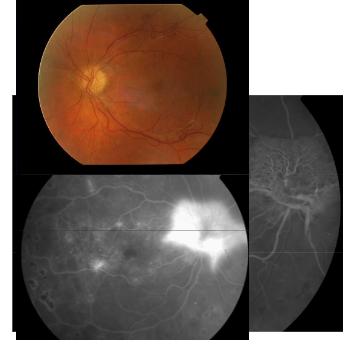 <p>Name this condition</p>