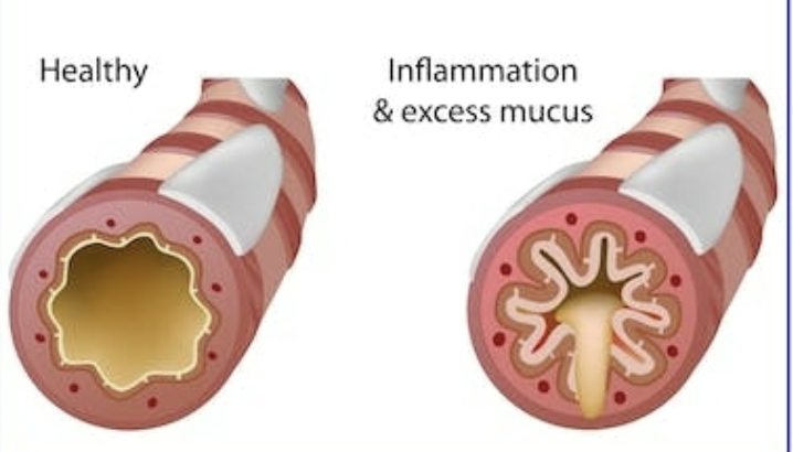 <p>what copd is shown in this image?</p>