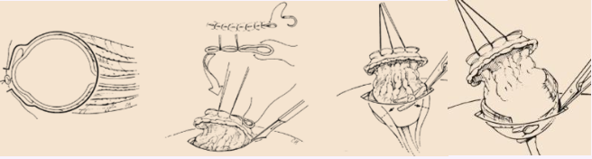 <p>1) Suture the eyelides closed (tarsorrhaphy) with a simple continuous pattern</p><p>2) Incise around the eyelid margin within 5 mm of the performed tasorrhaphy</p><p>3) Bluntly dissect posteriorly (don't penetrate the conjunctival sac)</p><p>4) Transect the optic nerve (+/- place right angle forceps along the optic nerve and vessels) using Metzenbaum scissors (+/- distal to the clamp)</p><p>5) Close the SQ tissue with a continuous pattern</p><p>6) Close the skin with simple interrupted sutures</p>