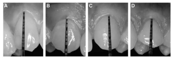 <ul><li><p>The phenotype indicates a dimension that may change through time depending upon environmental factors and clinical intervention and can be site-specific (phenotype can be modified, not the genotype). </p></li><li><p>Periodontal phenotype is determined by gingival phenotype (gingival thickness, keratinized tissue width), and bone morphotype (thickness of the buccal bone plate).</p></li><li><p>1) Probe visible: thin (ā¤1 mm).</p><p class="p1">2) Probe not visible: thick (> 1 mm).</p></li></ul><p></p>