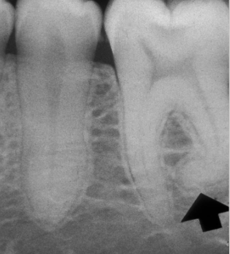 <p>from traume or infection of tooth bud as root is forming, tooth vital, usually 3rd problems, no problem with tooth unless endo is needed </p>