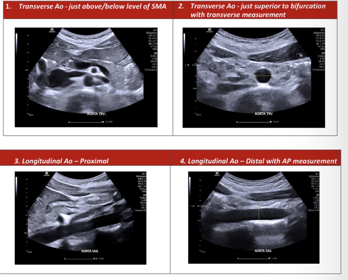 <p>Rotate 90 degrees back to the transverse plane beginning again at the xiphisternum slide down the proximal portion of the aorta and take image of the aorta and IVC just proximal or distal to the level of the SMA (image 1)</p><p>Slide inferiorly from there and image the distal arota just above the level of the bifurcation include a transverse measurement. (Image 2)</p><p>Turn to the longtudinal plane to visualise the proximal aorta demonstrating coeliac axis or SMA (Image 3)</p><p>Slide the transducer inferiorly to obtain a longtudinal image of the aorta in the distal segment just above the bifurcation.</p><p>Add an AP measurement in the distal image only (image 4)</p><p></p>