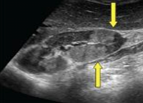 <p>increased cortical echogenicity </p><p>renal atrophy </p>