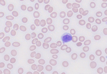 <p>Hint: There’s basophilic stippling</p>