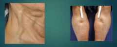 <p>- Pedal/ankle edema</p><p>- Jugular Venous Distention</p><p>- Hepatomegaly</p><p>- Pitting Edema</p>