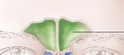 <p>An air-filled hollow space within a bone</p><p>The frontal _____ is inside the frontal bone, above the eyes</p>
