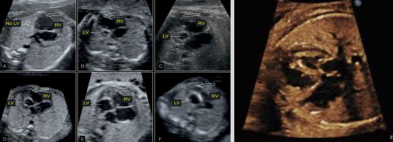 <ul><li><p><span style="background-color: transparent;">Most severe form of CHDs</span></p><ul><li><p><span style="background-color: transparent;">Most common cause of death from CHD in early neonatal period</span></p></li></ul></li><li><p><span style="background-color: transparent;">Underdevelopment of LV, MV, Ao, and AV</span></p></li><li><p><span style="background-color: transparent;">13% of all CHDs</span></p></li><li><p><span style="background-color: transparent;">More common in males</span></p></li><li><p><span style="background-color: transparent;">Always lethal</span></p></li><li><p><span style="background-color: transparent;">US findings:</span></p><ul><li><p><span style="background-color: transparent;">Small Ao</span></p></li><li><p><span style="background-color: transparent;">Small or absent LV</span></p></li></ul></li></ul><p></p>