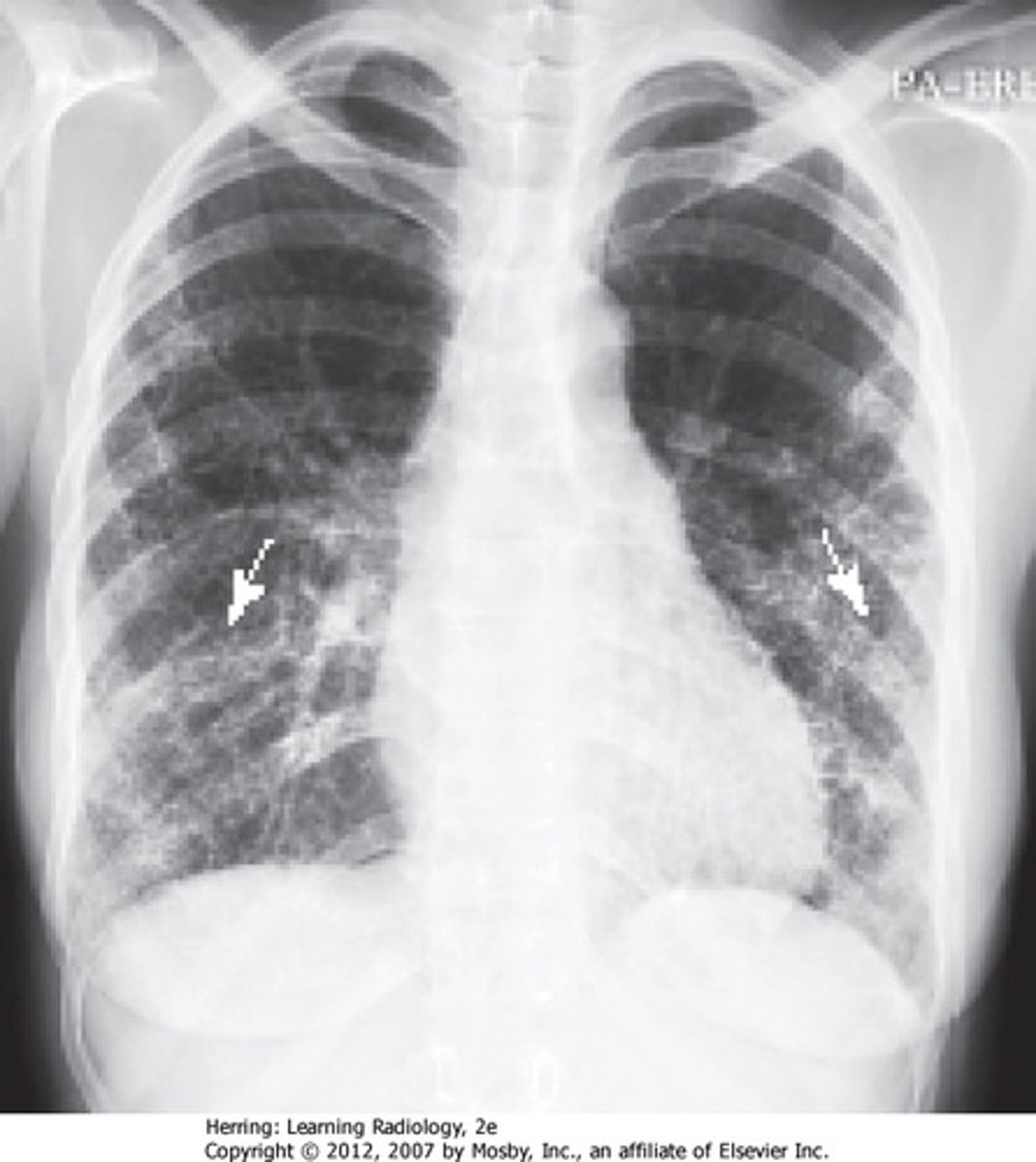 <p>abnormal dilation of the bronchi with accumulation of mucus</p>