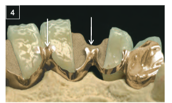 <p>Lingual occlusal surface</p>