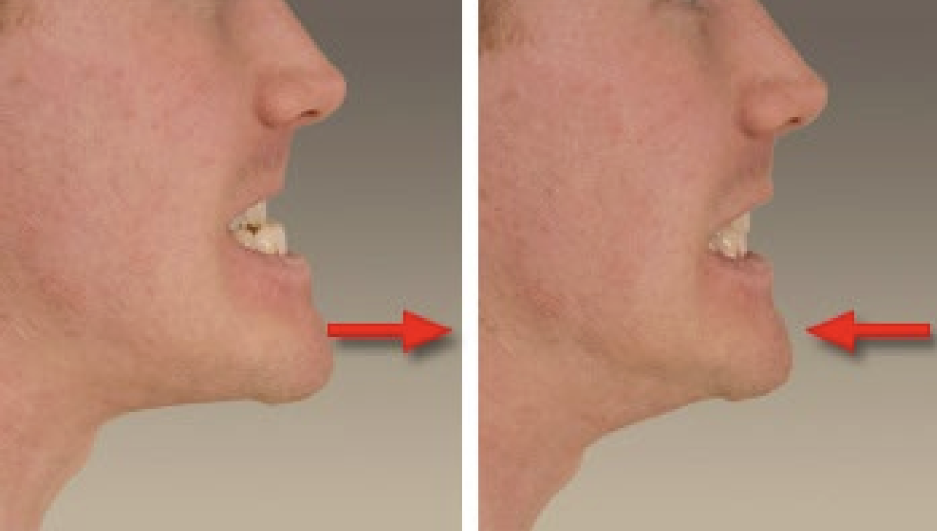<p>These are anterior-posterior gliding movements of the mandible within the upper compartment of the temporomandibular joint (TMJ).</p><p>• Protrusion and Retrusion are linear and do not involve rotation— unlike jaw opening/closing, which involve both rotation and translation.</p>