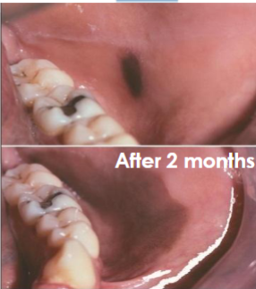 <p>rare, benign acquired dark melanosis of mucosa (reactive process) most commonly on the buccal mucosa. Solitary, asymptomatic, grows fast within weeks and is usually caused by trauma (like a toothbrush)</p>