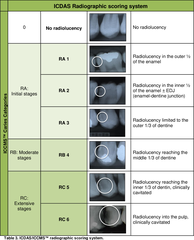 <p>What is the ICDAS score of a radiograph with radiolucency limited to the outer 1/3 of dentin?</p>