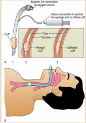 <p>-we can see that the endotracheal tube is placed within the airway</p><p>-the esophagus is on the posterior side and the trachea on the anterior</p><p>-the tube is a foot to a foot and a half long</p><p>-it passes through the mouth and then through the vocal cords</p><p>-a balloon is inflated to separate the upper and lower airway</p><p>^the balloon is not completely impervious to secretions, so we need to keep the HOB elevated</p><p>-our job is to make sure that the tube has the correct placement</p><p>^in the lungs, not the abdomen</p>