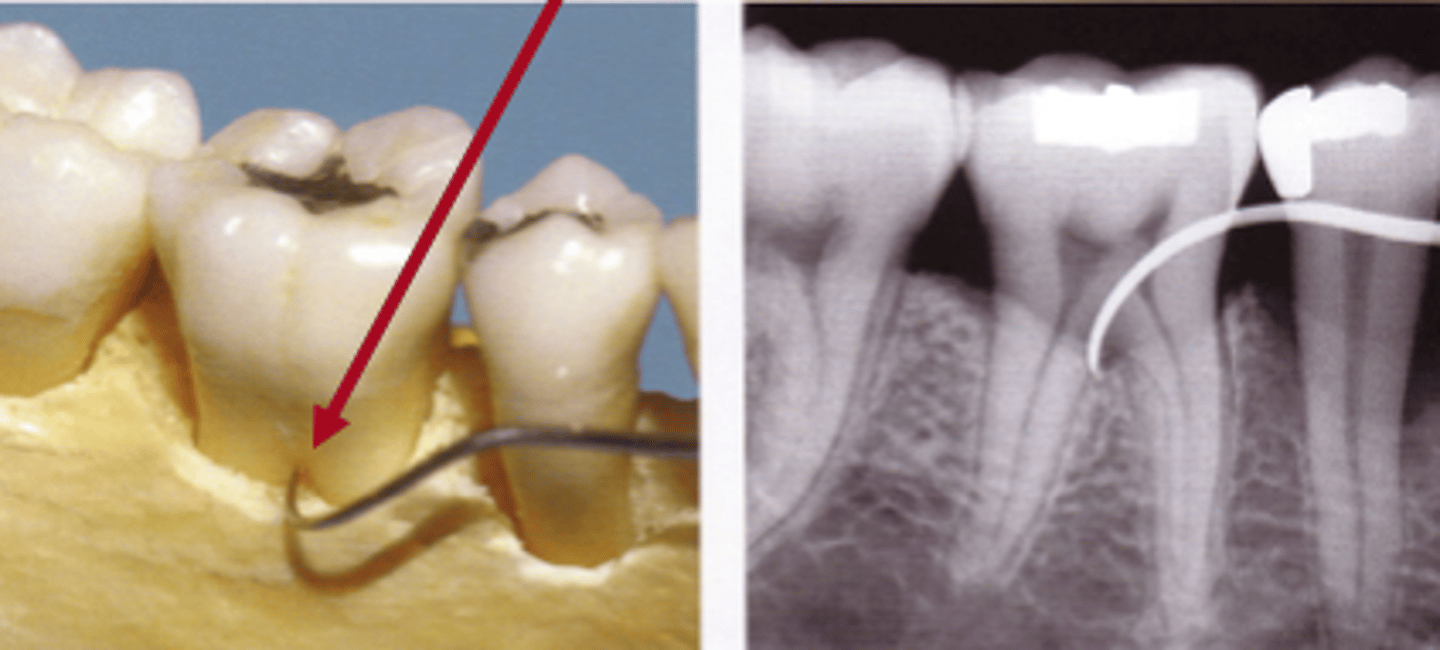 <p>definite horizonal component</p><p>not through and through</p><p>radiographic involvement possible</p>