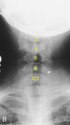 <p>AP Axial C-Spine: Is this Image Good?</p>