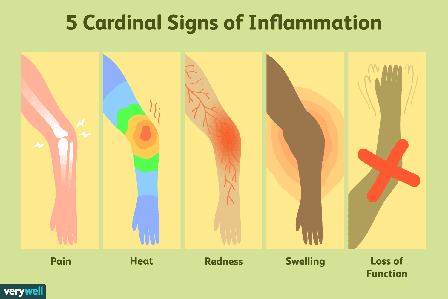 <p>Inflammation of</p>