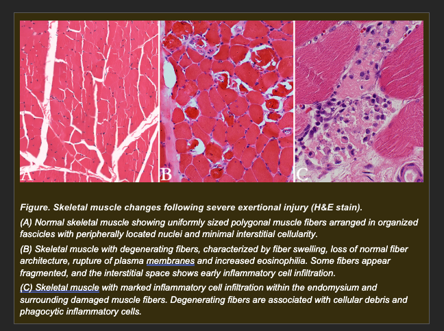<p>A performance horse collapses following extreme exertion. Muscle biopsies taken from the gluteal region show:</p><p>- Fiber swelling followed by rupture of plasma membranes</p><p>- Leakage of intracellular enzymes (creatine kinase, AST) into surrounding tissue</p><p>- Dense infiltration of inflammatory cells (neutrophils) into the affected region</p><p>- Ghost outlines of fiber architecture visible in some areas despite cell death</p><p>- ATP levels severely depleted in affected fibers</p><p></p><p><strong>Which interpretation best explains the mechanism responsible for the observed cellular injury and its consequences?</strong></p><p>a. ATP-dependent signaling activates a regulated cell death pathway that maintains membrane integrity and produces no inflammatory response</p><p>b. Reduced oxygen delivery produces reversible cellular swelling without loss of viability, expected to recover with reperfusion</p><p>c. Severe cellular injury exceeds the repair capacity of affected fibers, producing loss of plasma membrane integrity with release of intracellular contents and recruitment of inflammatory cells -- the hallmarks of necrosis</p><p>d. Controlled intracellular signaling pathways produce programmed cell shrinkage and apoptotic body formation without inflammatory recruitment</p>