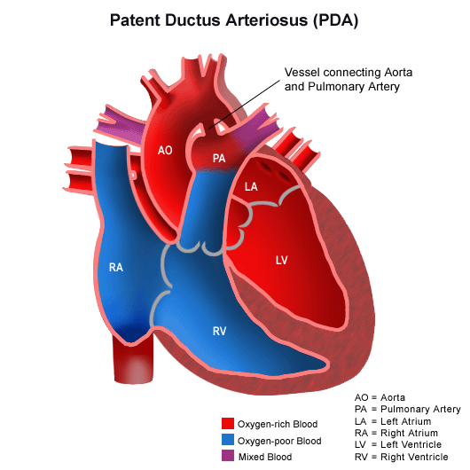 <p>patent ductus arteriosis (PDA) definition</p><ul><li><p>does position change this?</p></li><li><p>heard best where?</p></li><li><p>when do majority close?</p></li></ul><p></p>