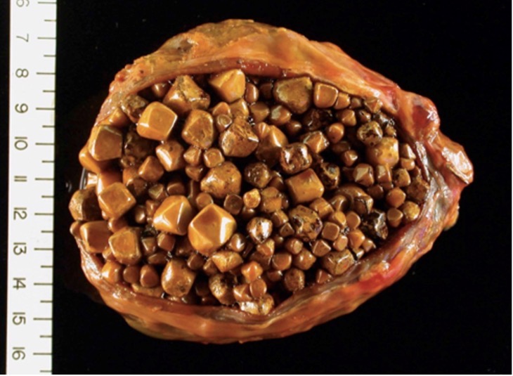 <p>What does <em>cholelithiasis</em> mean?</p>