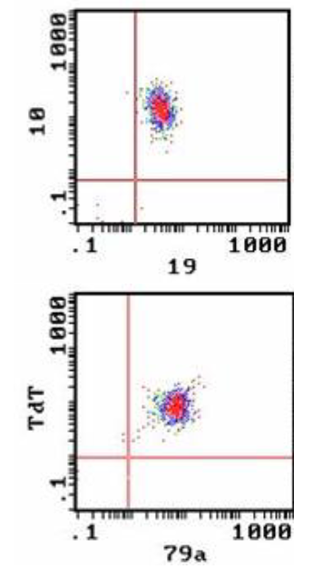 <p>- Flow cytometry to detect cell antigens associated with stage of differentiation and lineage</p><p>.</p><p>B-lineage ALL:</p><p>- CD10, CD19, cCD79a, TdT</p><p>- Usually CD34 positive</p><p>.</p><p>T-lineage ALL:</p><p>- CD2, CD3, CD7, TdT</p><p>- May express CD4 and / or CD8</p><p>- Usually CD34 negative</p>