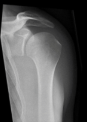 <p>Normal shoulder joint alignment</p>