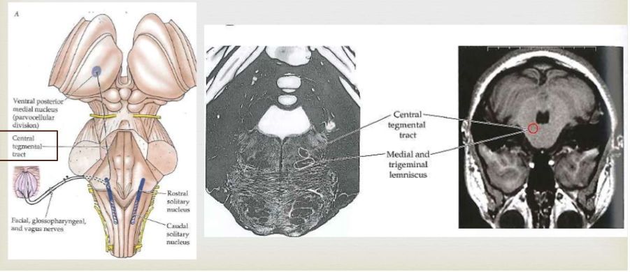 <p>Goes through pons and midbrain to thalamus</p>