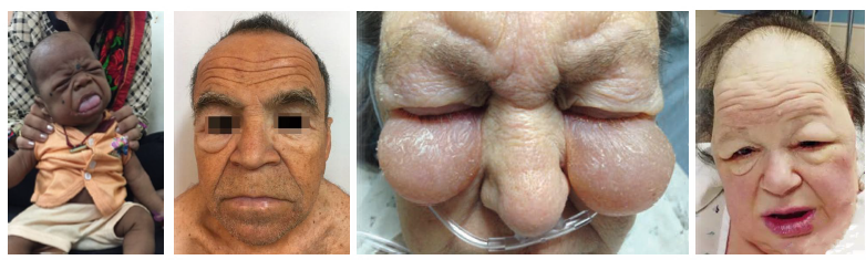 <p>•Diagnosis confirmed by thyroid hormone levels</p><p>•Managed with synthetic thyroid hormone therapy</p><p>•Early treatment prevents severe complications</p><p>•Monitor for delayed healing and xerostomia</p><p>•Dental care modified based on disease control</p>