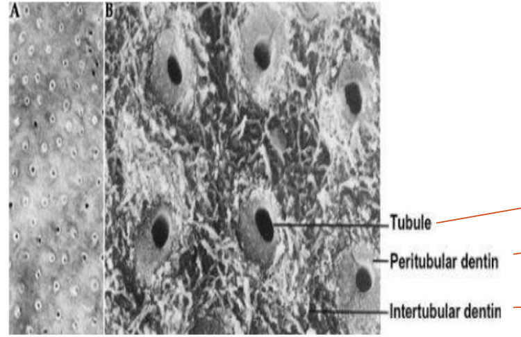 <p>The intertubular dentin, which lies between the tubules, is a less-calcified matrix that</p><p>consists of some apatite crystals embedded within a collagen matrix</p>