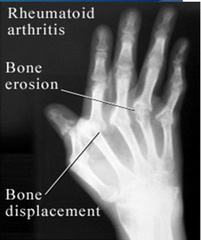 <p>Bone erosion/displacement, joint space loss, ulnar deviation of MCPs, periarticular osteopenia</p>