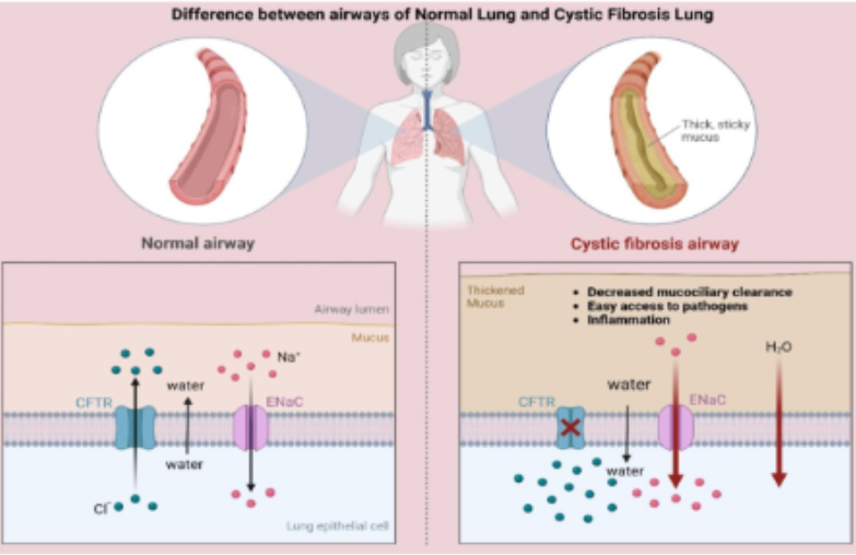 <p>What is the significance of cystic firbosis </p>