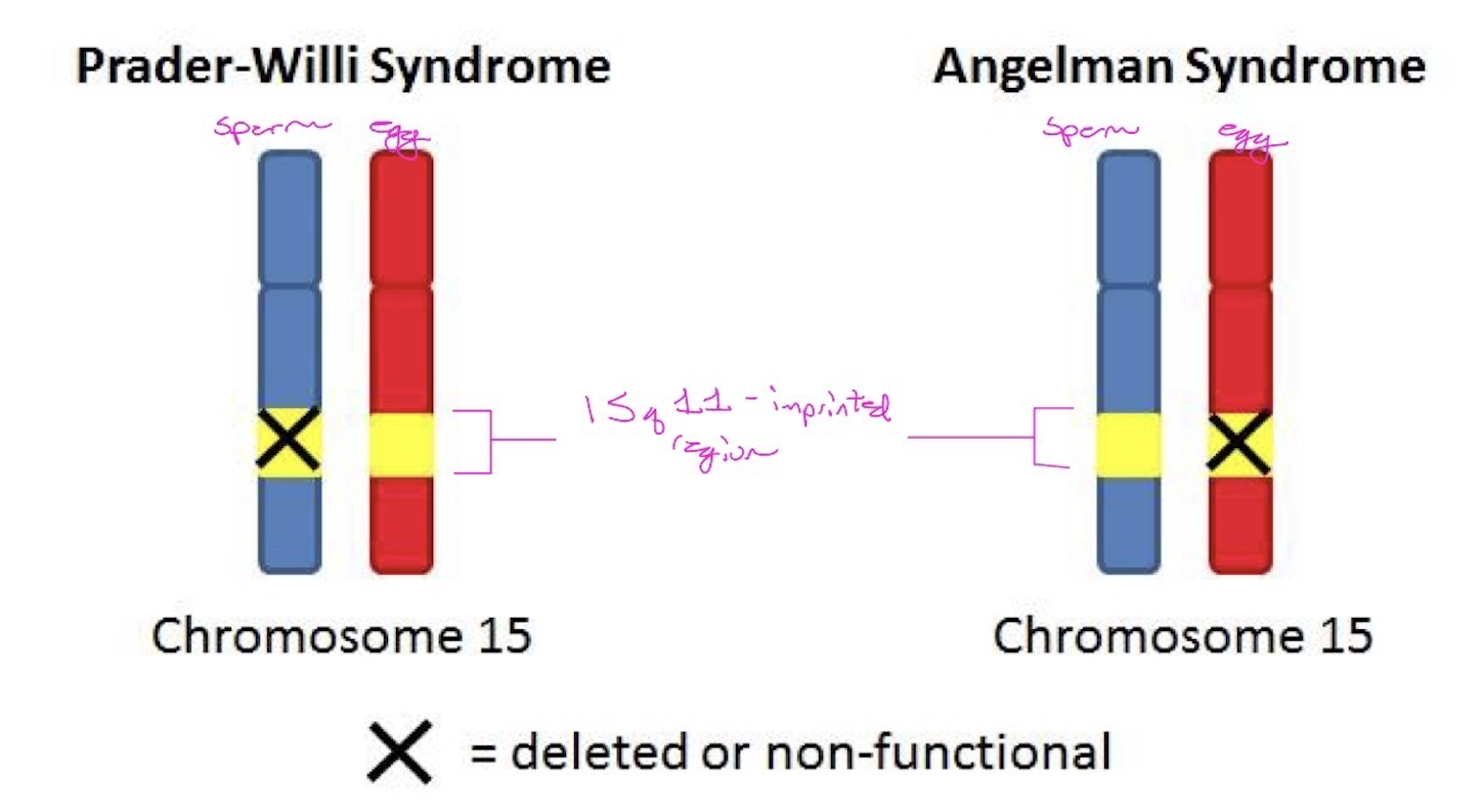 <p><strong>Prader-Willi syndrome</strong> and <strong>Angelman syndrome</strong> are two different syndromes, which are both linked to the same imprinted region of chromosome 15. In this imprinted region some of the genes are silenced in the egg-derived chromosome and some are silenced in the sperm-derived chromosome. Therefore, a defect on chromosome 15 will lead to loss of different gene activities, depending on whether the chromosome came from the egg or the sperm. </p><ul><li><p>In <strong>Prader-Willi syndrome</strong>, gene activity that normally comes from the <em>sperm</em> is missing. </p></li><li><p>On the other hand, on <strong>Angelman syndrome</strong> gene activity that normally comes from the <em>egg</em> is missing.</p></li></ul><p></p>