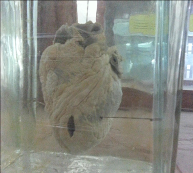 <p>Questions</p><ol><li><p>What is the specimen being examined?</p></li><li><p>What are the descriptive features of the injury on the heart?</p></li><li><p>What is the likely causative instrument for this type of injury?</p></li><li><p>How is the time of death estimated in relation to the injury?</p></li><li><p>What are the possible causes of death?</p></li><li><p>What is the final diagnosis for this specimen?</p></li></ol><div data-type="horizontalRule"><hr></div><p></p><p></p>