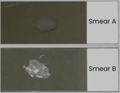 <p>Before air-drying and heat-fixing this specimen, your lab technician asks you which smear to use. Which smear (A or B) has an appropriate thickness for staining?</p><p> </p><p>Smear A is better; its liquid appearance ensures that the cells will settle in several layers.</p><p> </p><p>Smear A is better; it contains fewer cells, resulting in more accurate staining and more clearly visible cell morphology.</p><p> </p><p>Smear B is better; it contains more cells so there is less likelihood the cells would wash away during staining.</p><p> </p><p>Smear B is better; it contains more cells which will be easier to find when using the microscope.</p>