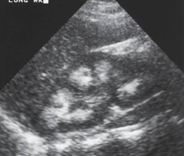 <p>bilaterally enlarged kidneys, hyperechoic pyramids </p><ul><li><p>can appear as nephrocalcinosis </p></li></ul><p></p>