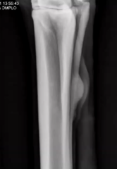 <p>What is the etiology for 2nd and 4th metacarpi (splint bone) exostosis?</p>