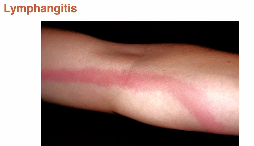<p>fever, chills, rapid breathing, increased HR, increased WBCs lymphangitis</p><p>Septic shock - tissue damage and organ failure due to decreased BP/perfusion</p><p></p><p>Treatment: antibiotics and support (IV fluids and oxygen)</p>