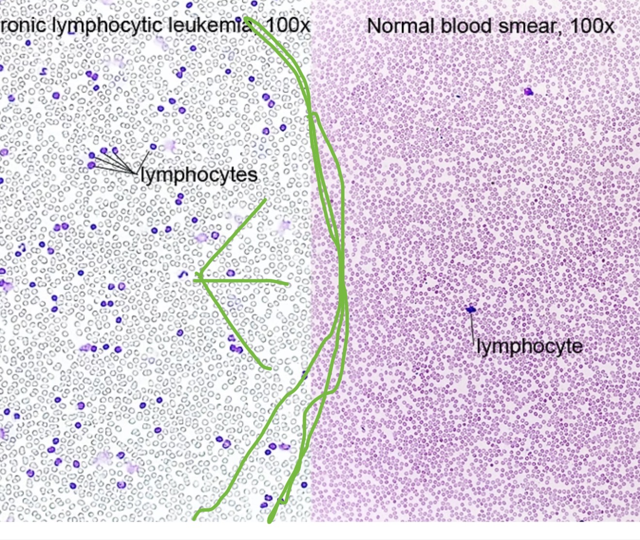 <p><span><span>cancer involving an abundance of leukocytes (leukemia); bone marrow makes too many lymphocytes</span></span></p>